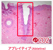CO2フラクショナルレーザーの効果
