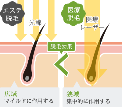 エステ脱毛と医療脱毛の脱毛効果の違いは波長にある