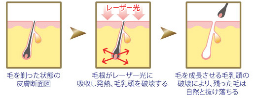 成長期　毛が成長している時期　退行期　毛の成長が止まっている時期　休止期　毛が抜け落ちる時期