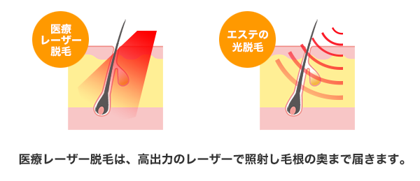 医療レーザー脱毛は、高出力のレーザーで照射し毛根の奥まで届きます。