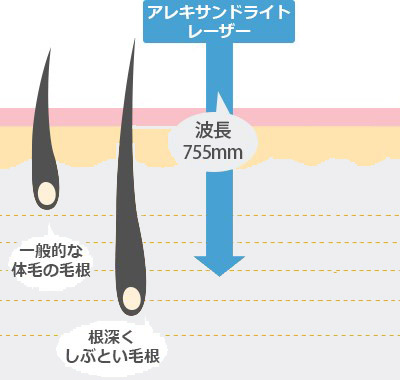 医療レーザー脱毛機の種類とレーザー波長の長さ