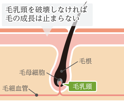 毛乳頭を破壊しなければ毛の成長は止まらない