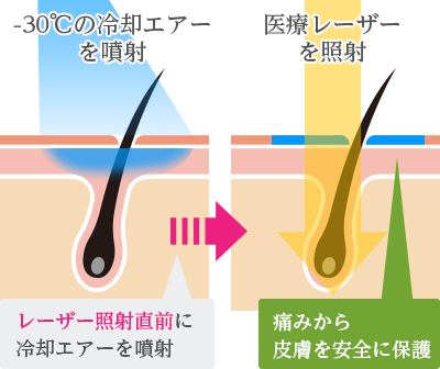 皮膚科医が解説 医療レーザー脱毛は痛い 痛み の理由と 痛み軽減対策 へのこだわりについて 広尾プライム皮膚科