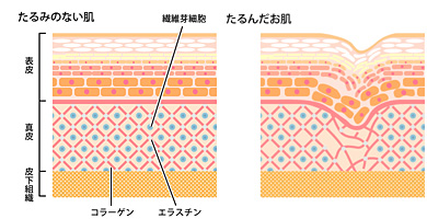 たるみジワ