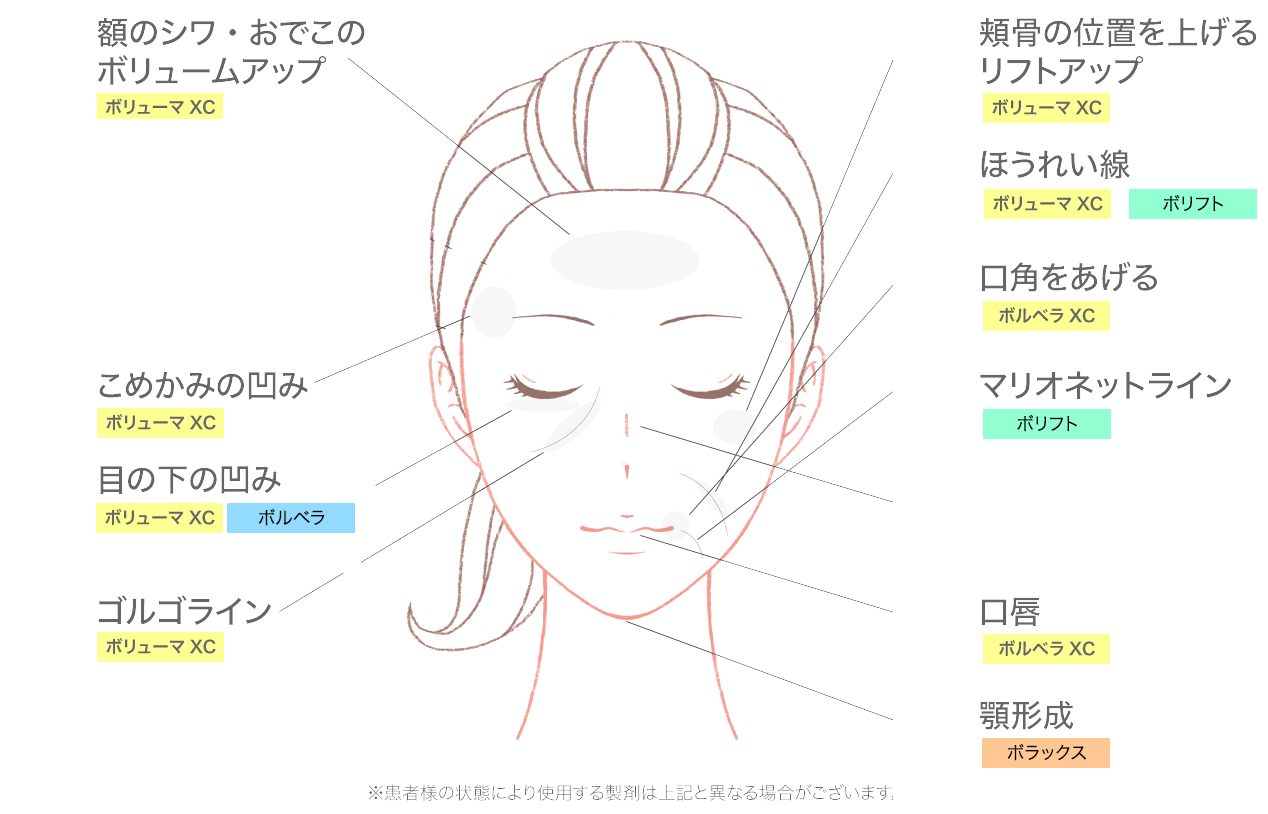 ヒアルロン酸注射