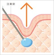 ヒアルロン酸注射