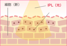 2.フォトフェイシャル照射中