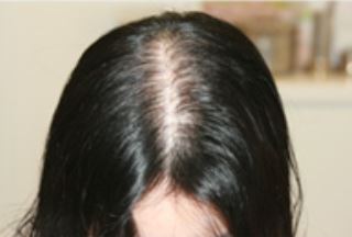 女性の薄毛　HARG療法