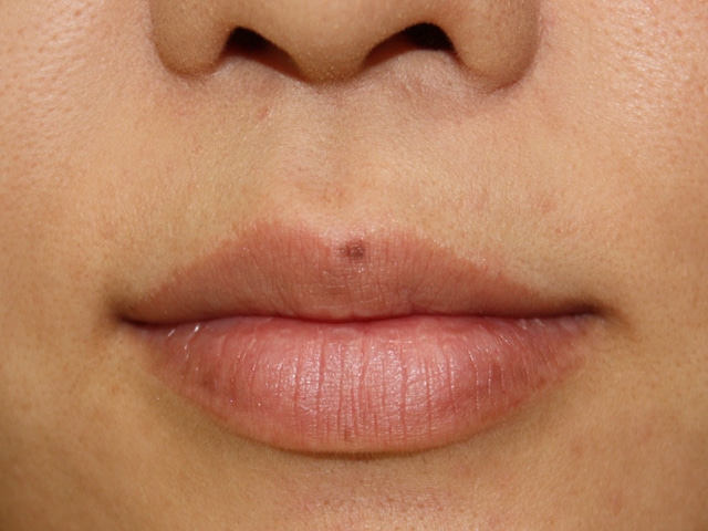 Co2 炭酸ガス レーザー 公式 美容皮膚科を東京でお探しなら広尾プライム皮膚科クリニック 東京都渋谷区 恵比寿駅徒歩5分