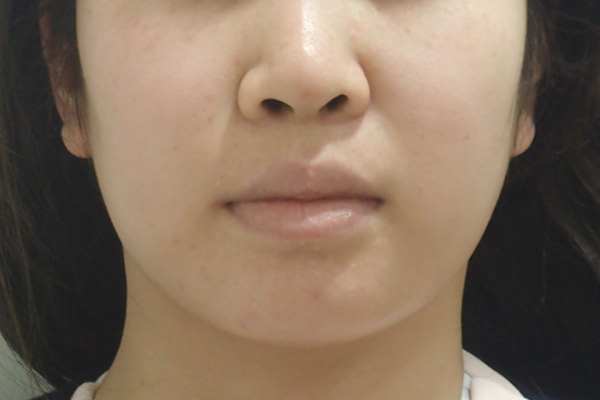 小顔注射 Bnlsneo 公式 美容皮膚科を東京でお探しなら広尾プライム皮膚科クリニック 東京都渋谷区 恵比寿駅徒歩5分 小顔注射 Bnlsneo 公式 美容皮膚科を東京でお探しなら広尾プライム皮膚科クリニック 東京都渋谷区 恵比寿駅徒歩5分